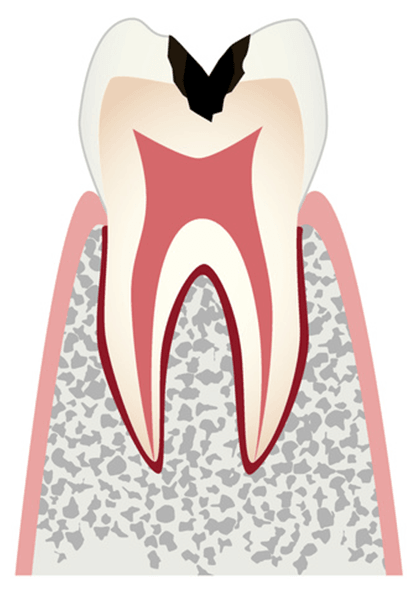 歯の内部（象牙質）まで進行したむし歯
